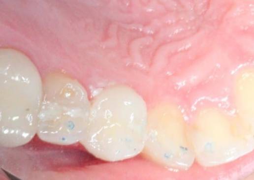 Fractured Tooth before treatment