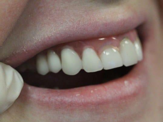 Replace Missing Teeth before treatment