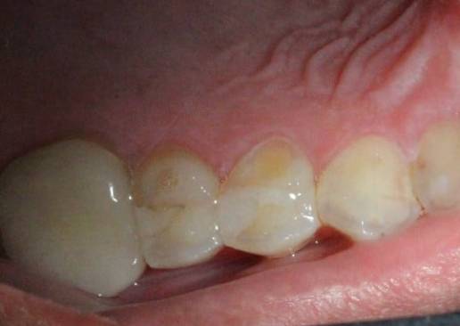 Fractured Tooth before treatment