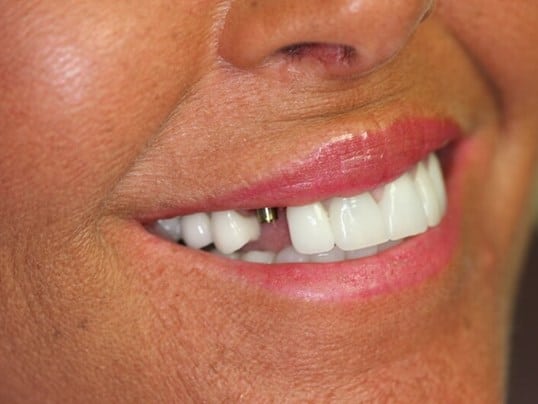 Chipped front tooth before treatment