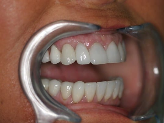 Chipped front tooth before treatment