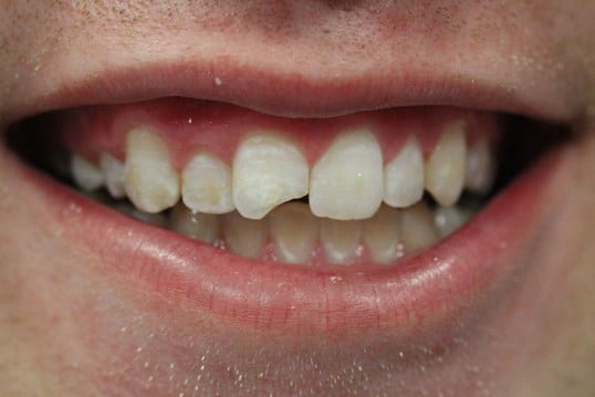 Chipped front tooth before treatment