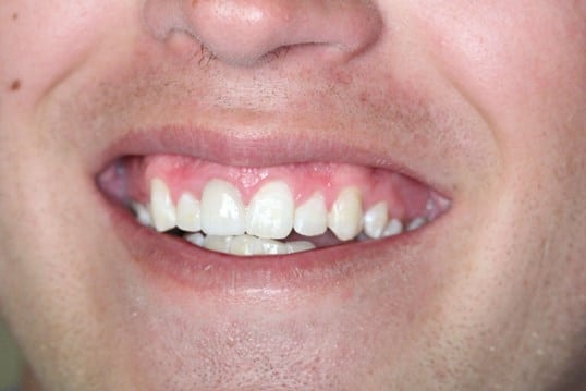 Chipped front tooth before treatment