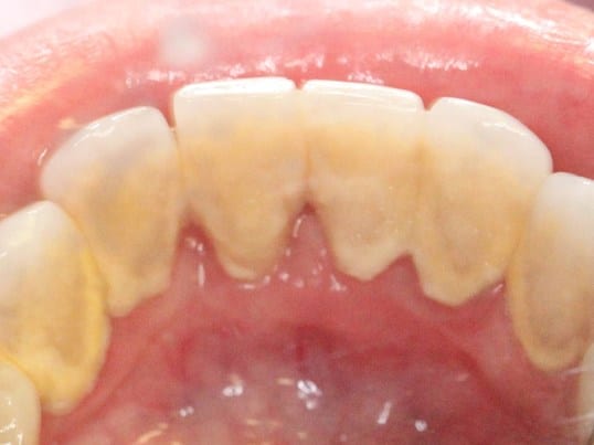 In Needs of A Cleaning before treatment