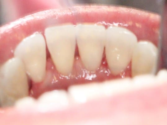 In Needs of A Cleaning before treatment