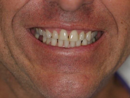 Smile Improvement before treatment