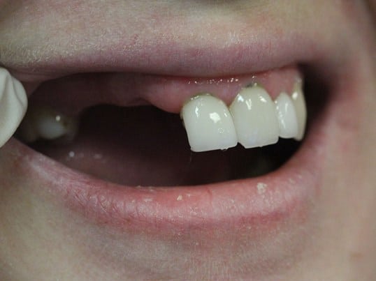 Replace Missing Teeth before treatment