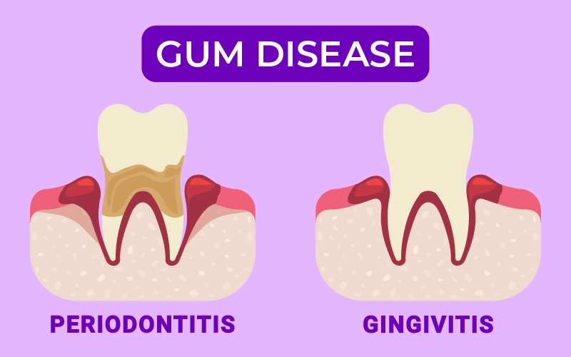 Stages of Gum Disease