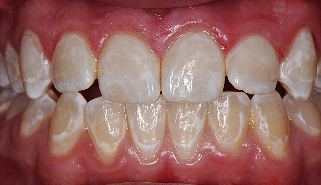 White Spots on Teeth
