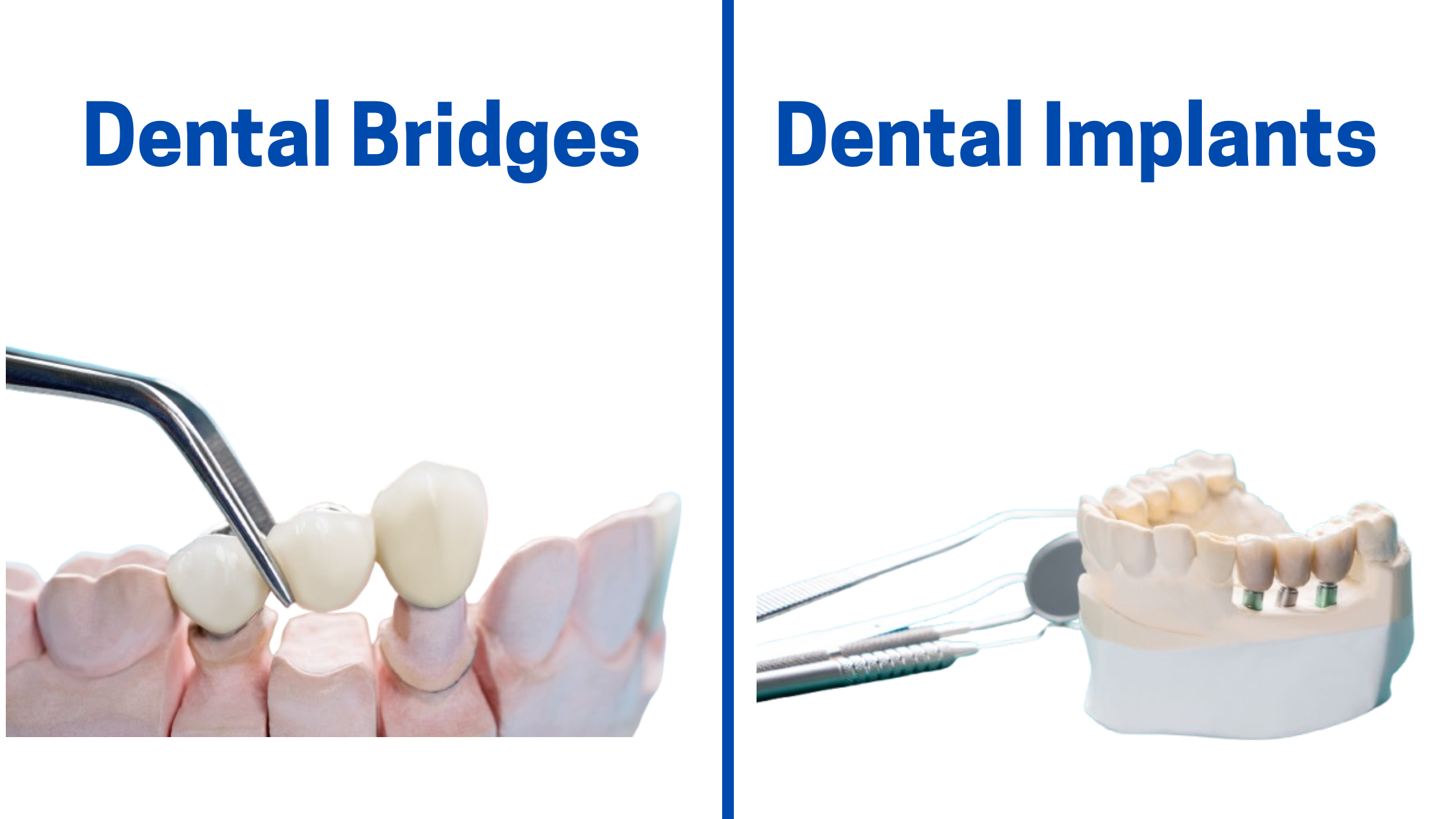 Difference between Dental bridges and implants