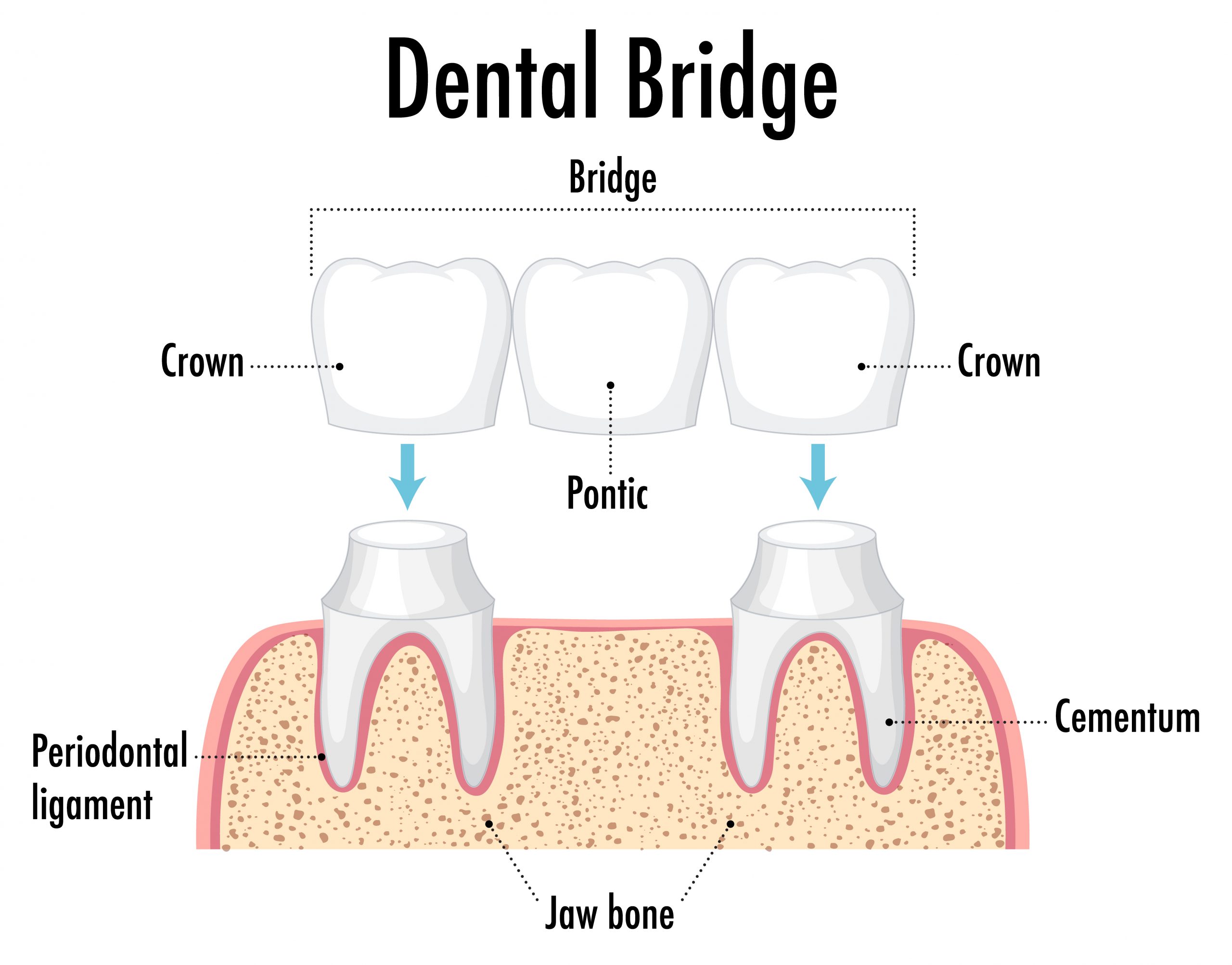 Dental Bridge Procedure