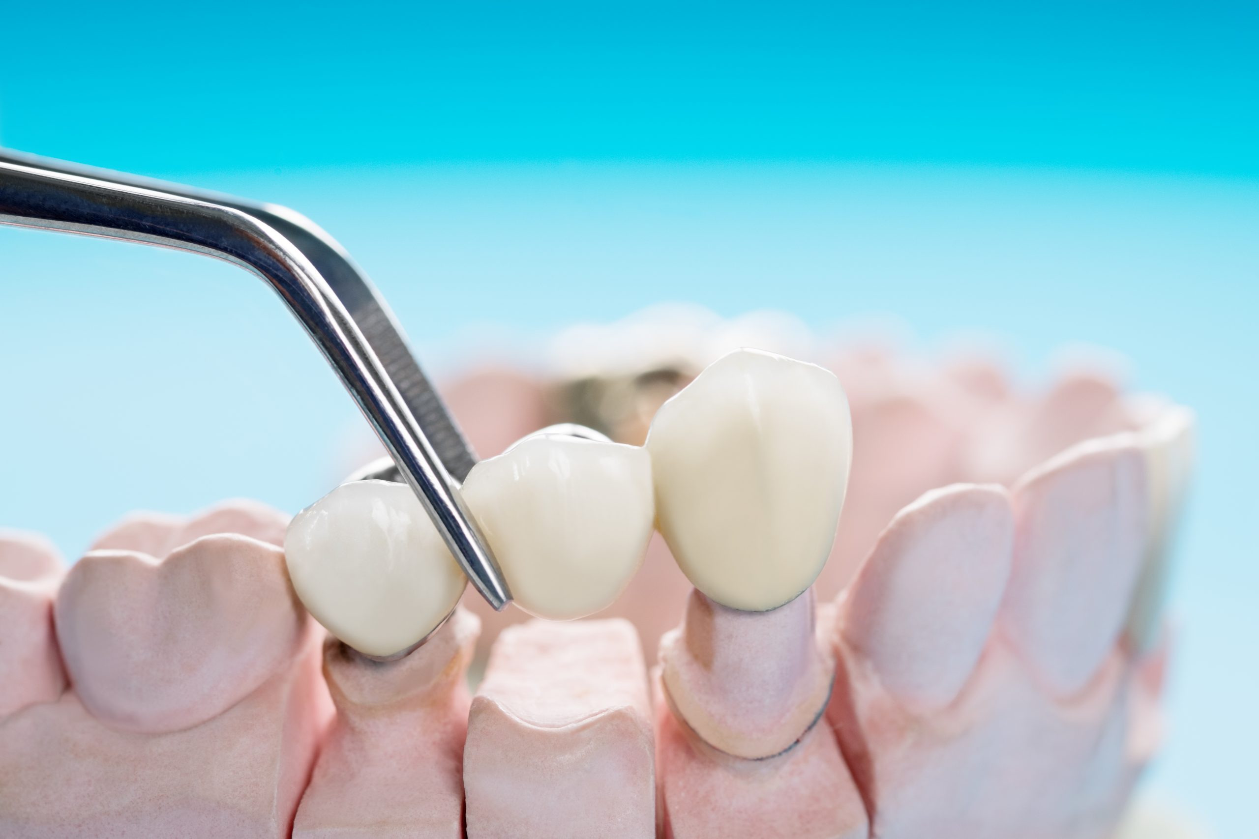 What to Expect With a Dental Bridge
