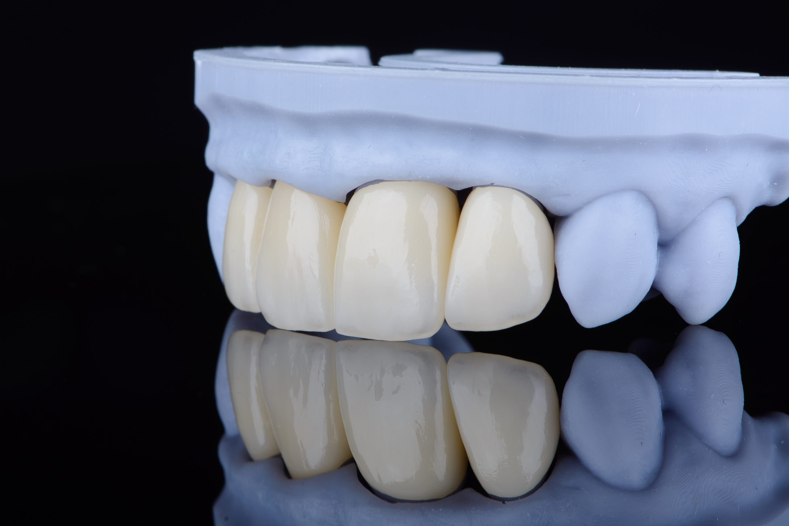 How Long Does a Dental Bridge Last?