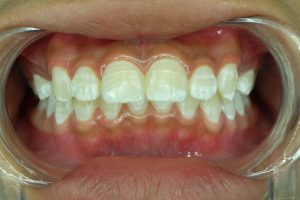 Why White Spots on Teeth?