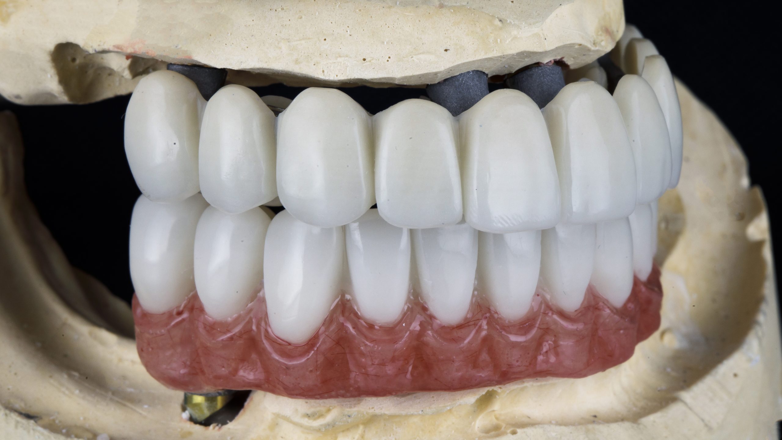 Front Teeth Bridge