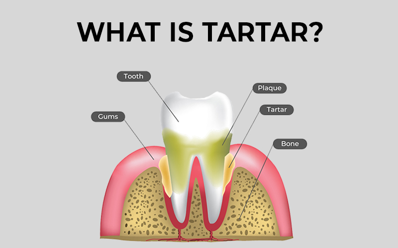 What is tartar?