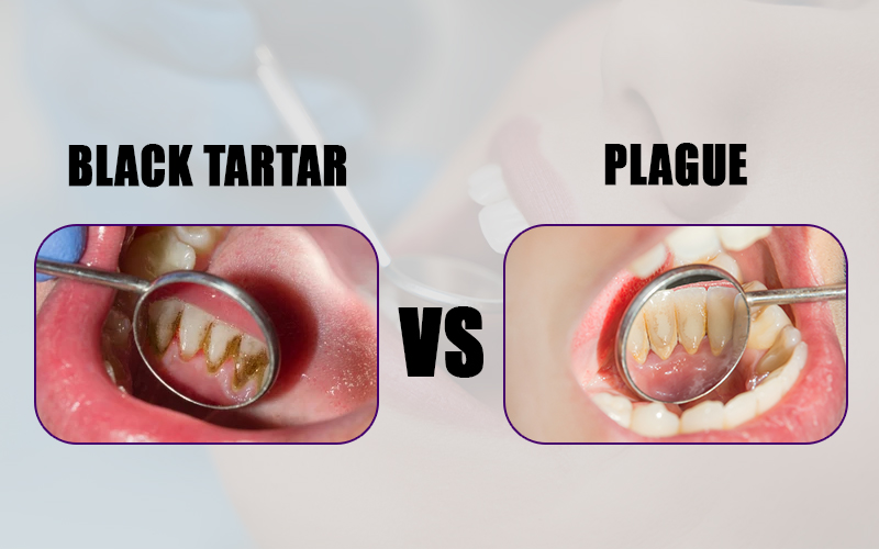 Black Tartar vs Plaque