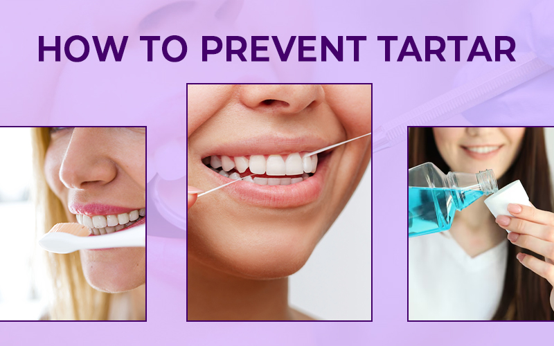 Tartar on teeth