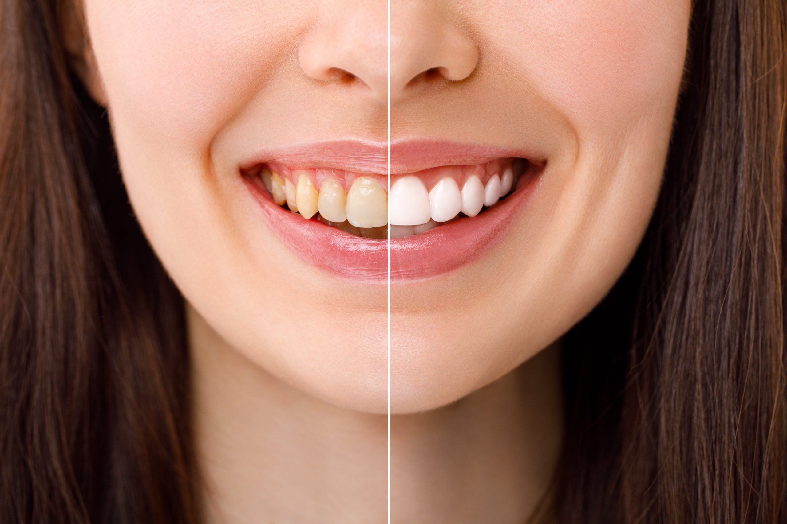 Teeth whitening while pregnant