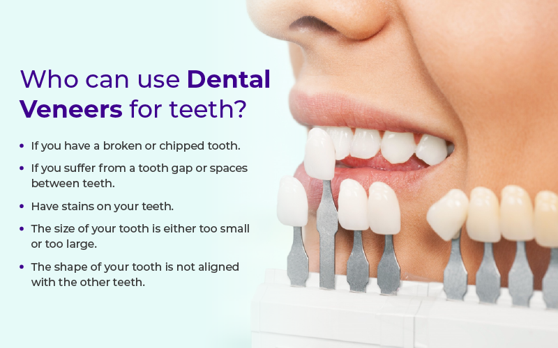 Who can use dental veeners for teeth?