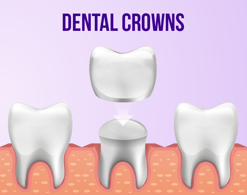 Dental Crowns