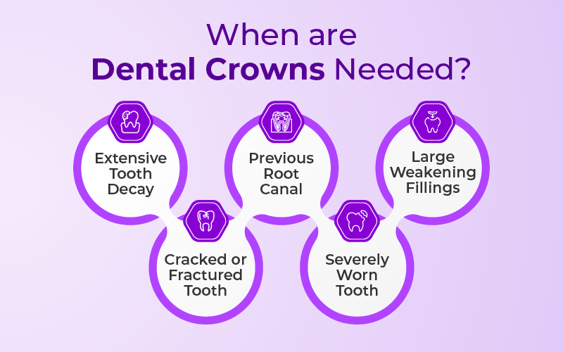 When are Dental Crowns Needed?