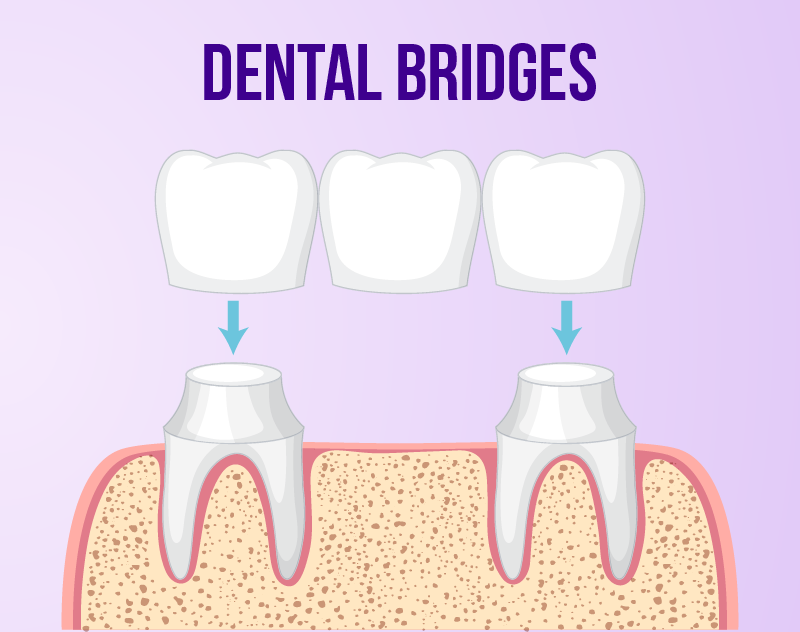 Dental Bridges