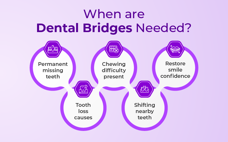 When are Dental Bridges Needed?