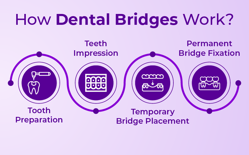 How Dental Bridges Work?
