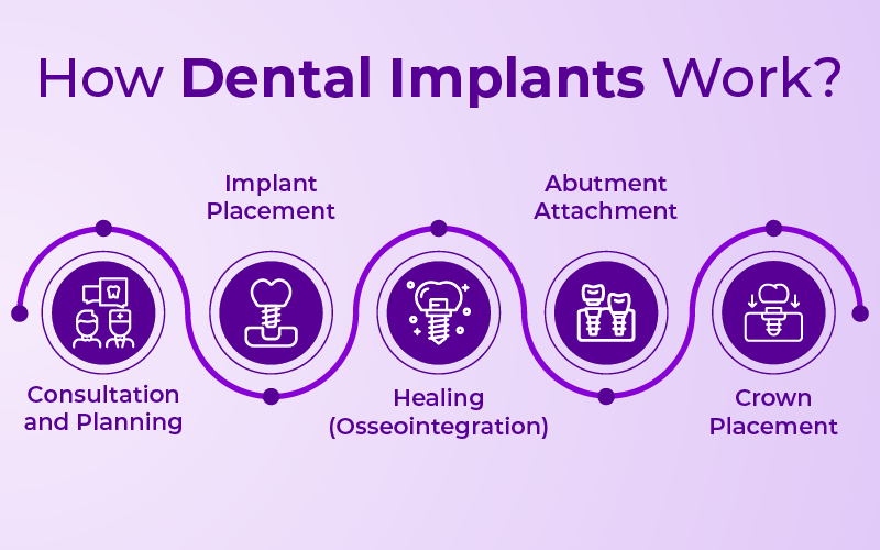 How Dental Implants Work?