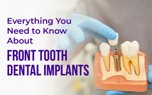 Everything You Need to Know About FRONT TOOTH DENTAL IMPLANTS