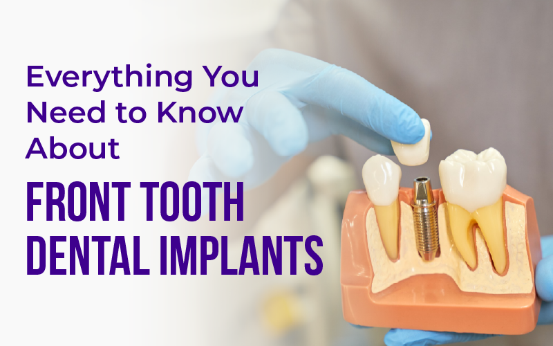 Everything You Need to Know About FRONT TOOTH DENTAL IMPLANTS