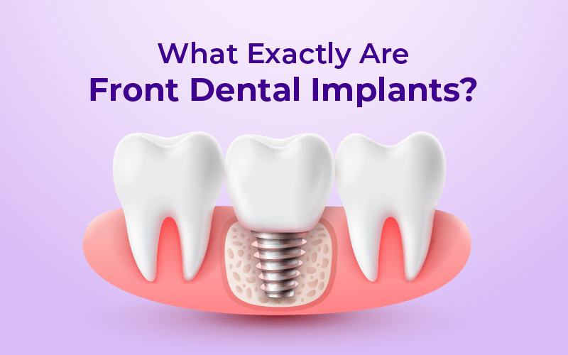 What Exactly Are Front Dental Implants?