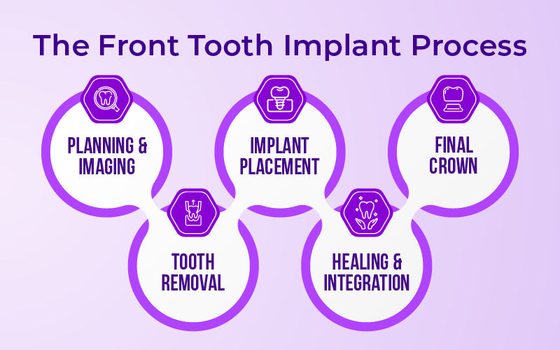 The Front Tooth Implant Process