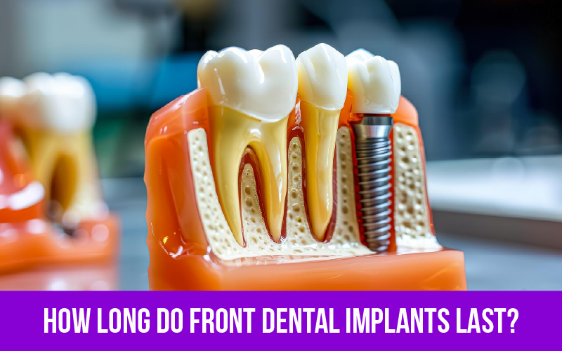 How Long Do Front Dental Implants Last?