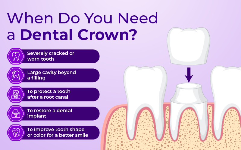 What Is the Purpose of a Dental Crown? 