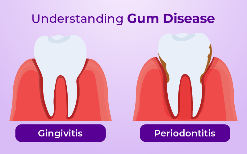 Understanding Gum Disease