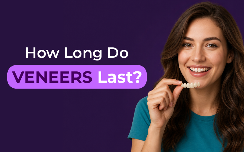 How Long Do Veneers Last?