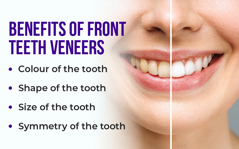 Benefits of Front Teeth Veneers