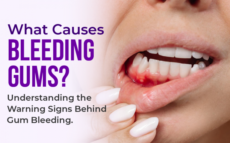 What Causes Bleeding Gums? Understanding the Warning Signs Behind Gum Bleeding