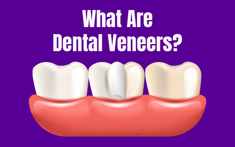 What Are Dental Veneers?
