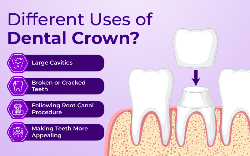 Different Uses of Dental Crowns