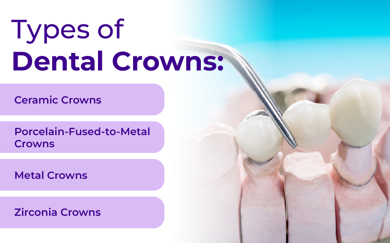 Types of Dental Crowns