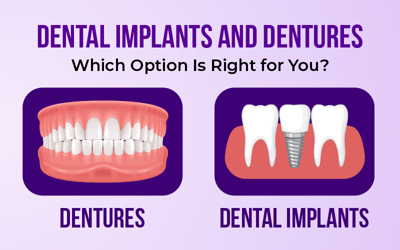 Dental Implants and Dentures: Which Option Is Right for You?