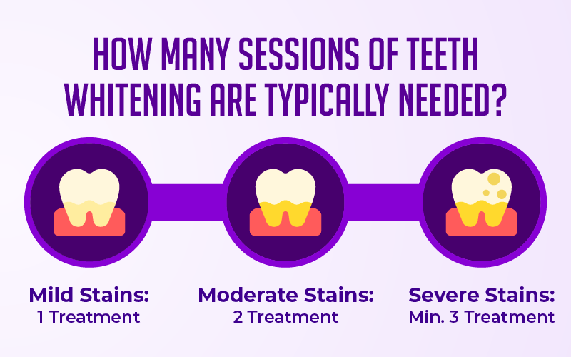 How Many Sessions of Teeth Whitening Are Typically Needed?