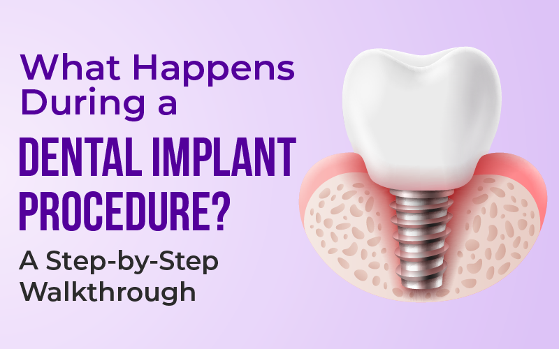 What Happens During a Dental Implant Procedure? A Step-by-Step Walkthrough