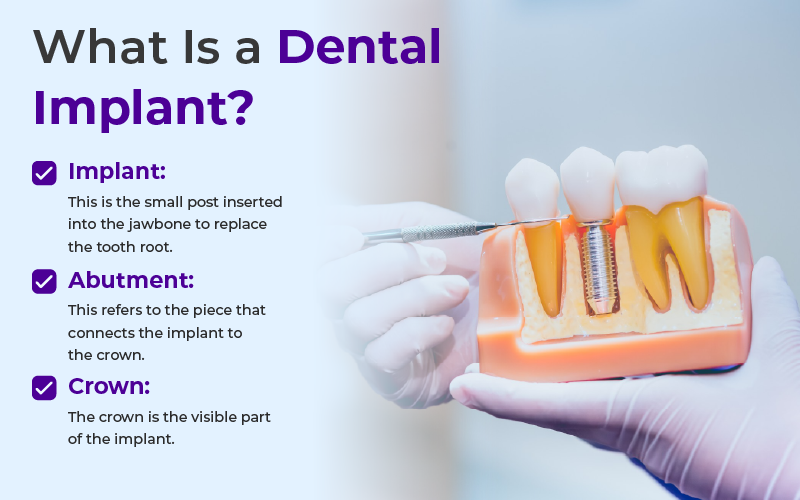 What Is a Dental Implant?