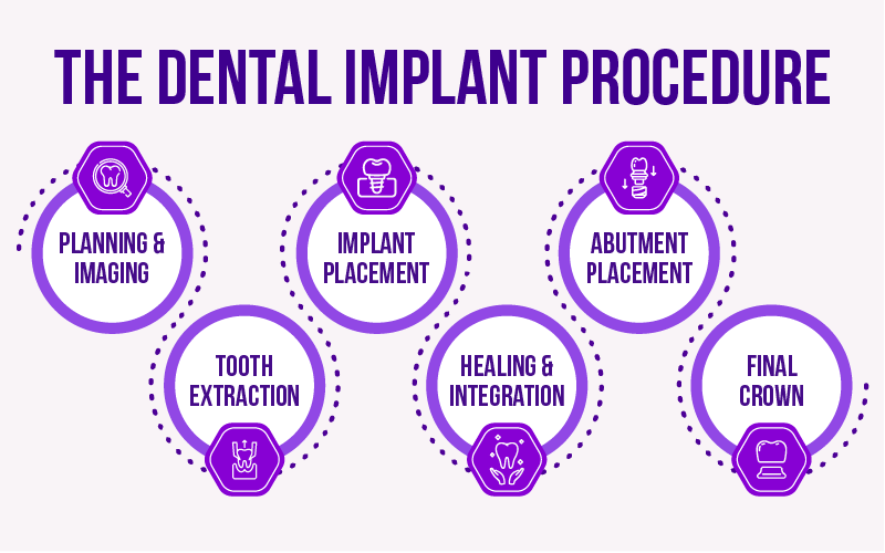 The Dental Implant Procedure