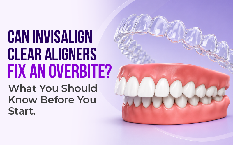 Can Invisalign Clear Aligners Fix an Overbite? What You Should Know Before You Start