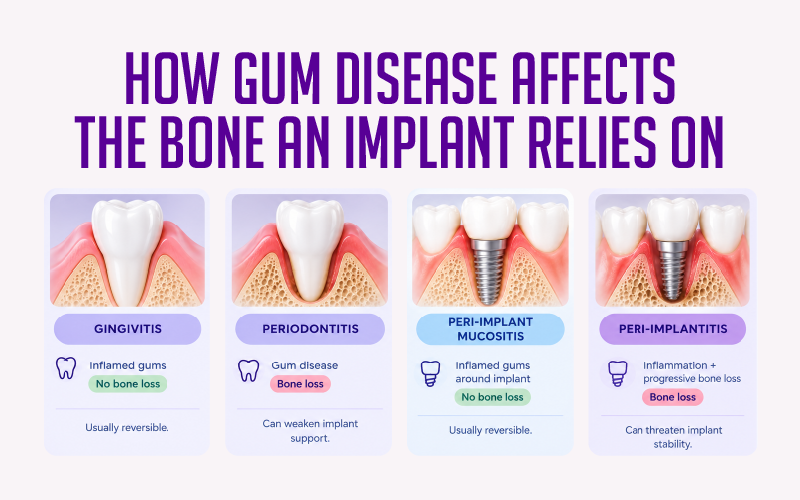 How Gum Disease Affects the Bone an Implant Relies On